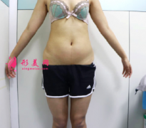 鄭州華領(lǐng)整形醫(yī)院全身多維立體吸脂案例 恢復(fù)苗條身材