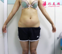 鄭州華領(lǐng)整形醫(yī)院全身多維立體吸脂案例 恢復(fù)苗條身材