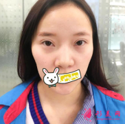 上海華僑整形醫(yī)院鼻綜合整形案例 側(cè)顏簡直美呆了 很自然哦