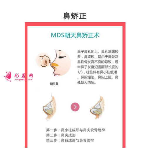 朝天鼻如何矯正