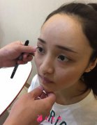 面部脂肪凹陷填充案例，術(shù)后少女感十足！