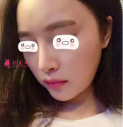 假體隆鼻好嗎？看看我的真實(shí)案例吧~