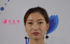 瘦臉針效果好不好？看我的術(shù)后恢復(fù)吧~