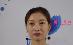 瘦臉針效果好不好？看我的術(shù)后恢復(fù)吧~