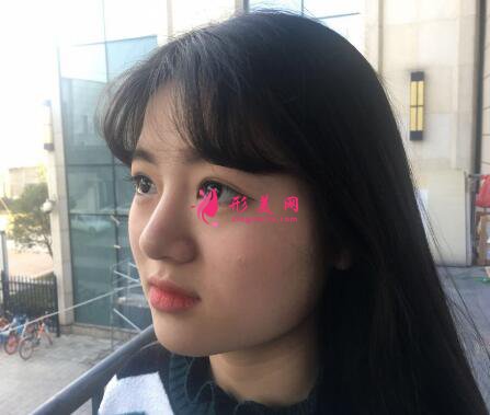 瘦臉針有效嗎？看我術(shù)后恢復(fù)效果怎么樣！
