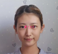假體隆鼻哪種好？親身經(jīng)歷講述~