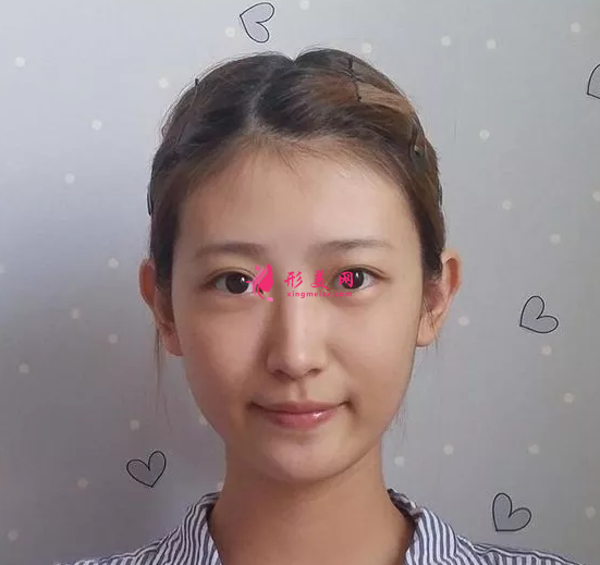 假體隆鼻哪種好？親身經(jīng)歷講述~