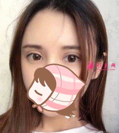 變美日記分享：埋線雙眼皮多久能恢復(fù)？