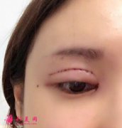 變美日記分享：埋線雙眼皮多久能恢復(fù)？