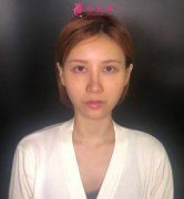 黑眼圈如何去除？填充玻尿酸淚溝+黑眼圈解決