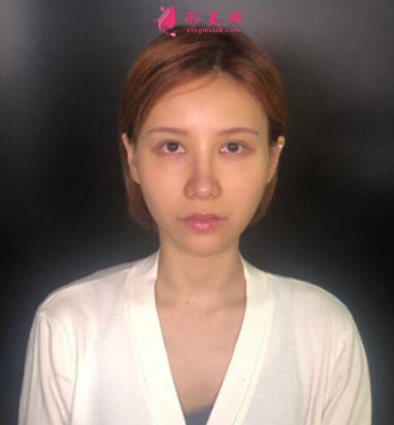 黑眼圈如何去除？填充玻尿酸淚溝+黑眼圈一步解決