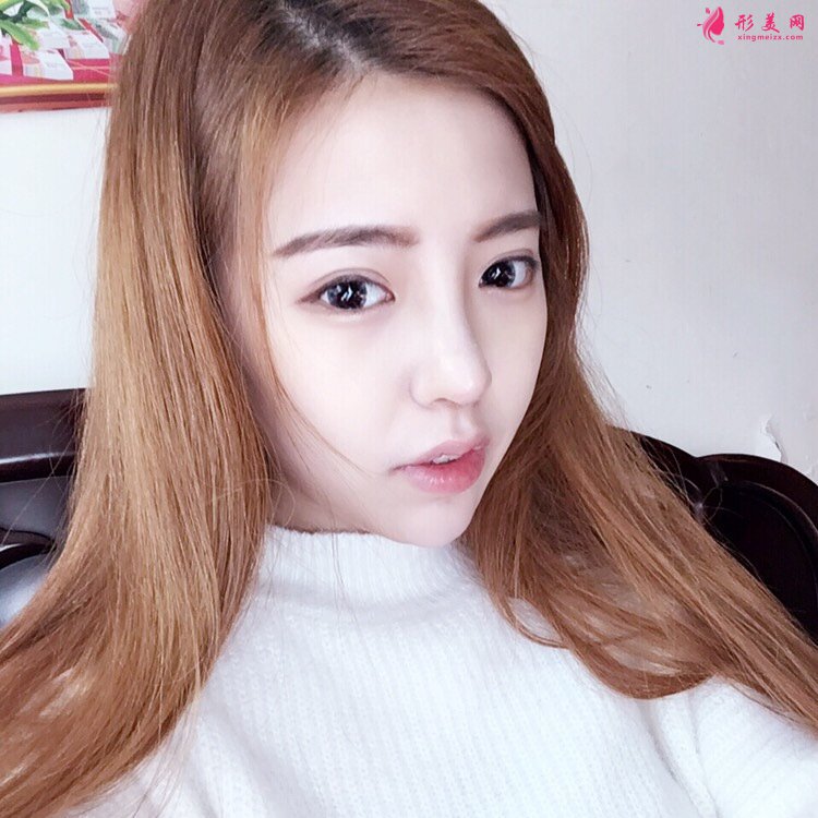 鼻頭鼻翼縮小手術(shù)案例，術(shù)后恢復(fù)全記錄！