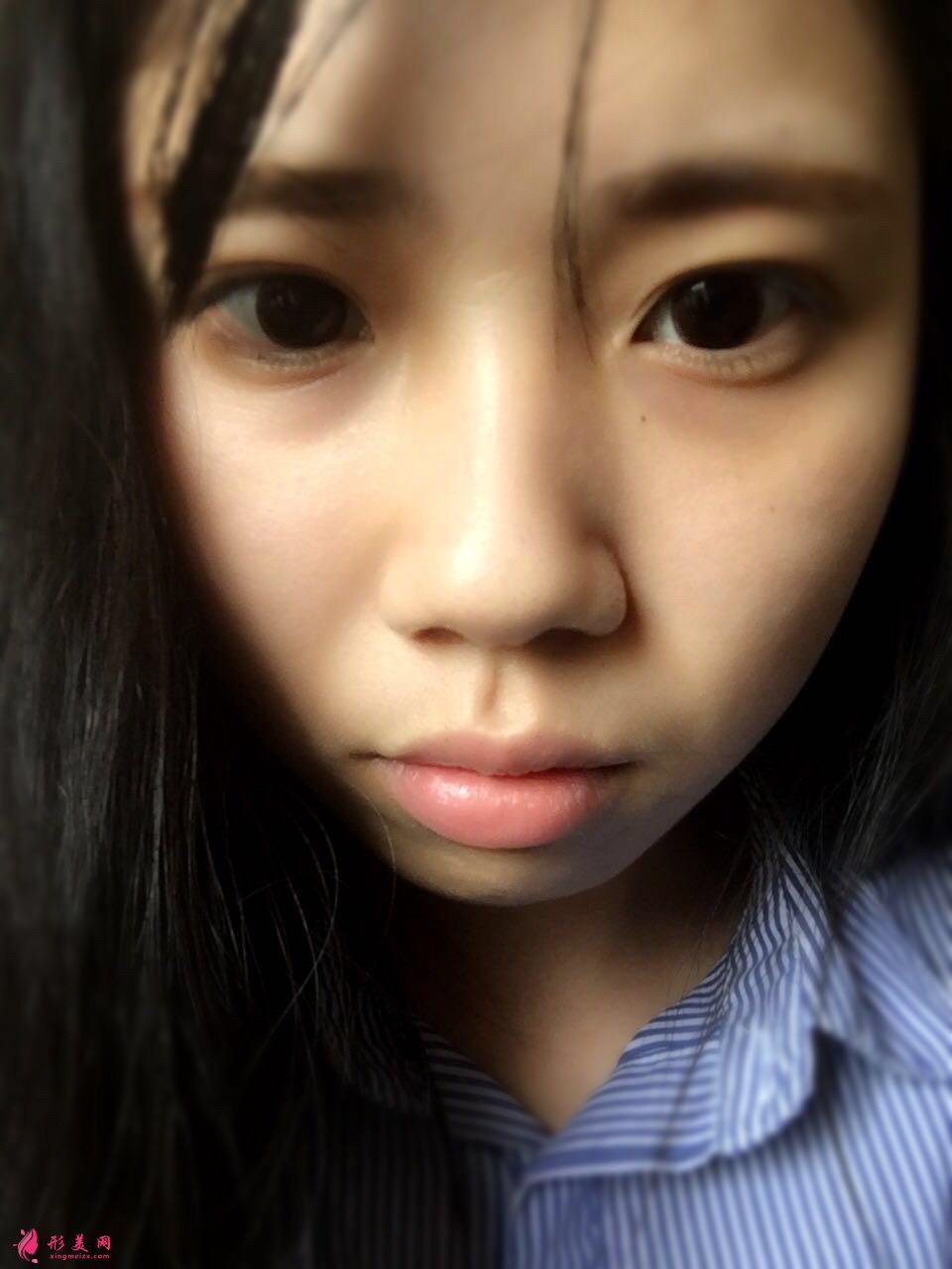 軟骨隆鼻手術(shù)要多少錢？真人案例對比圖來了！