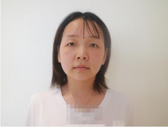 上海九院眼部整形案例分享｜30天恢復效果圖展示