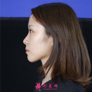西安西京整形科鼻綜合手術(shù)術(shù)后恢復(fù)效果分享