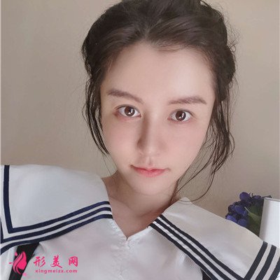 上海鼻修復(fù)術(shù)后恢復(fù)案例反饋 術(shù)后 上海鼻修復(fù)術(shù)后恢復(fù)案例反饋