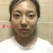杭州維多利亞面部線雕提升術(shù)后案例分享
