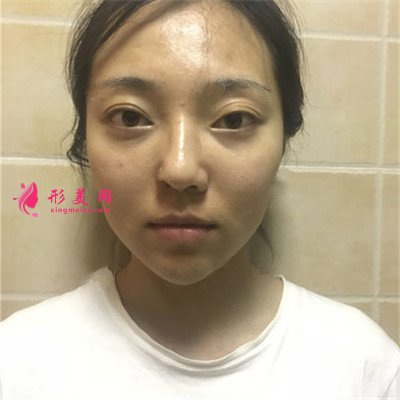 杭州面部線雕提升術(shù)后案例分享