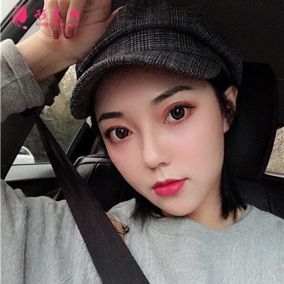 杭州面部線雕提升術(shù)后案例分享