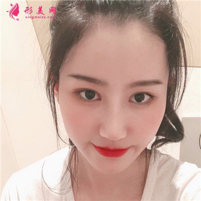 成都自體肋軟骨隆鼻恢復(fù)效果反饋