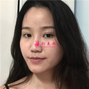 成都圣丹福整形美容醫(yī)院自體肋軟骨隆鼻恢復效果反饋