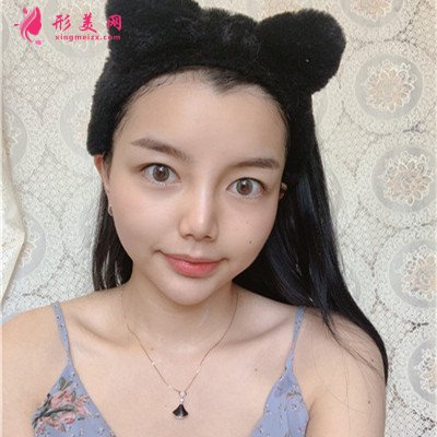 溫州膨體隆鼻術(shù)后效果分享