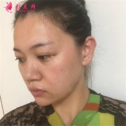 上海伯思立整形面部線雕提升，幫你重回年輕面貌