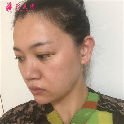 上海面部線雕提升，幫你重回年輕面貌