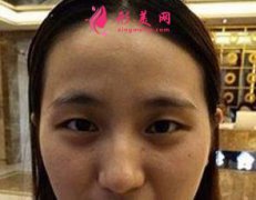 上海時光整形雙眼皮手術恢復圖片 術后效果分享