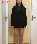 去廣州星團(tuán)找趙輝做了吸脂瘦大腿,終于瘦下來(lái)了