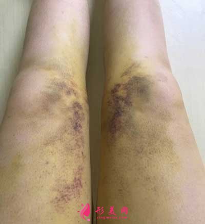 去廣州星團找趙輝做了吸脂瘦大腿手術后第3天