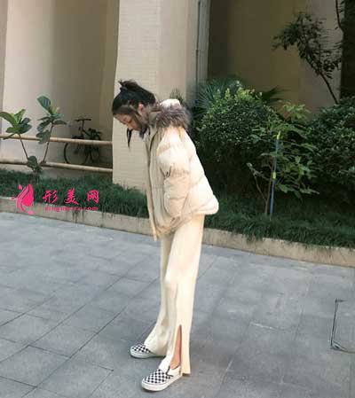 去廣州星團找趙輝做了吸脂瘦大腿手術后第8天