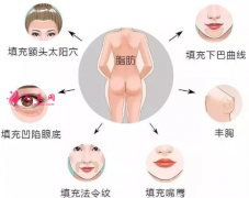 自體脂肪填充后遺癥有哪些？