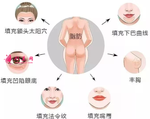自體脂肪填充后遺癥有哪些