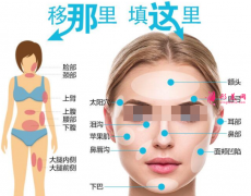 自體脂肪填充多久恢復自然