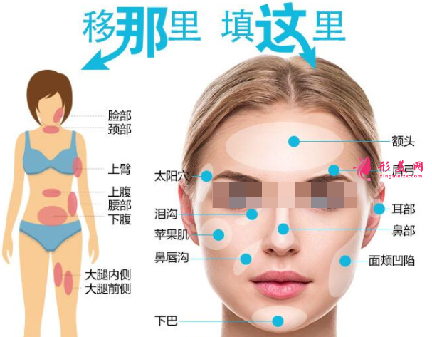 自體脂肪填充多久恢復(fù)自然