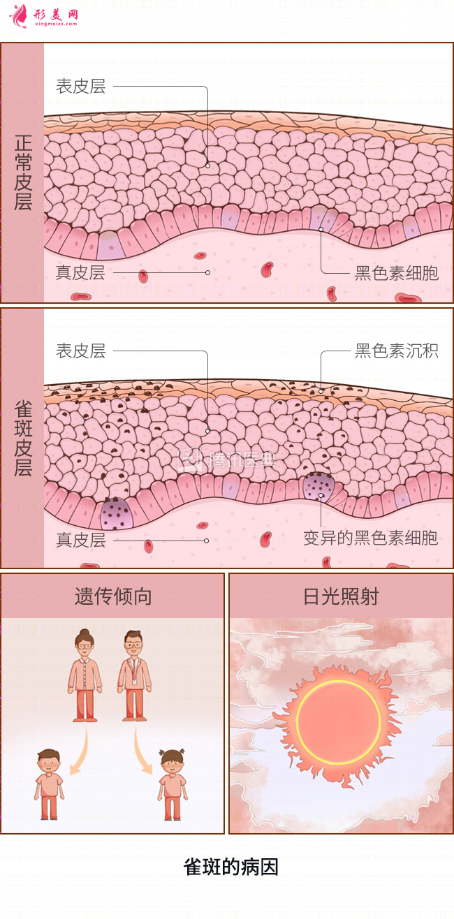 臉上的雀斑要怎么去掉