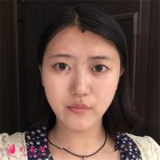 鄭州華領整形醫(yī)院切開雙眼皮手術恢復情況對比
