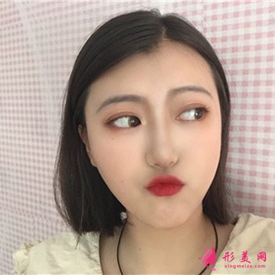 廈門切開雙眼皮手術(shù)恢復(fù)情況對比 術(shù)后 廈門切開雙眼皮手術(shù)恢復(fù)情況對比