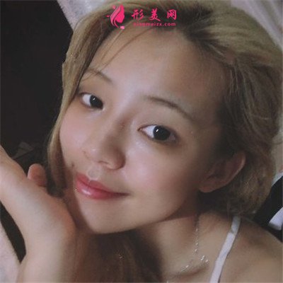 廈門小姐姐全切雙眼皮術(shù)后恢復(fù)效果分享