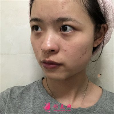 深圳眼綜合術(shù)后恢復(fù)案例分享