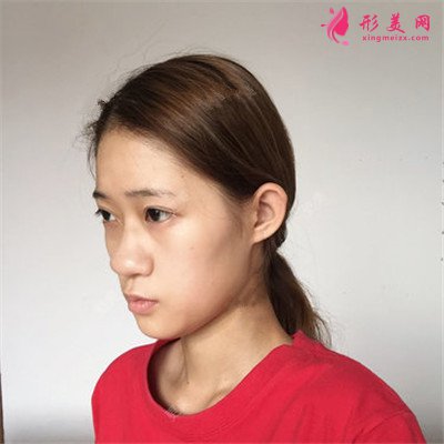 合肥膨體隆鼻案例反饋，小姐姐長的很可愛呢~