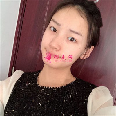 成都眼部修復(fù)術(shù)后案例反饋