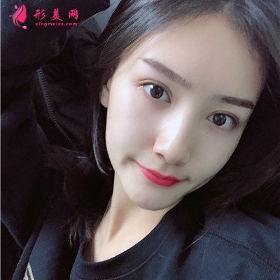成都眼部修復(fù)術(shù)后案例反饋 術(shù)后 成都眼部修復(fù)術(shù)后案例反饋