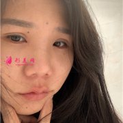 上海華美醫(yī)療美容醫(yī)院硅膠假體隆鼻術(shù)后效果反饋