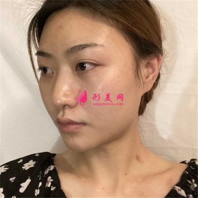 武漢耳軟骨隆鼻術后恢復情況分享