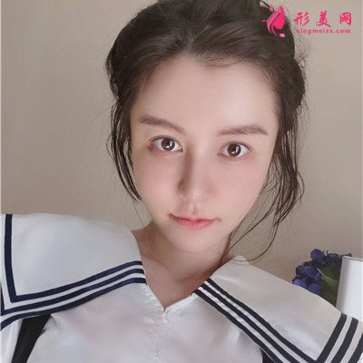上海鼻修復(fù)術(shù)后恢復(fù)案例反饋 術(shù)后 上海鼻修復(fù)術(shù)后恢復(fù)案例反饋