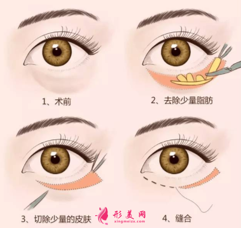 眼袋手術(shù)大概需要多少錢