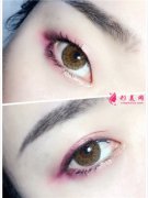 不適合做雙眼皮手術(shù)的人群有哪些？