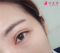 三種割雙眼皮手術(shù)的方法，你知道哪一種？